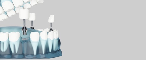 Essential Facts About Dental Crowns: A Comprehensive Guide