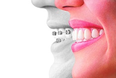 Transform Your Smile with Portsmouth and Ashland Invisalign: A Comprehensive Guide