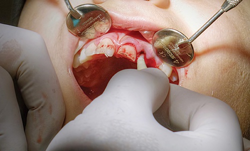 How Can a Dental Trauma Specialist Assess and Treat Jaw Injuries?