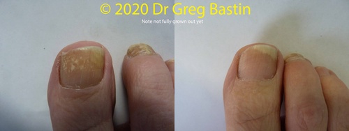 Are Laser Solutions the Future of Nail Fungus Treatment?