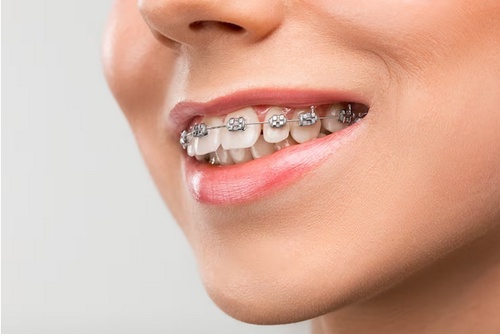 Straight from Essex: A Comprehensive Guide to Braces and Beautiful Smiles"