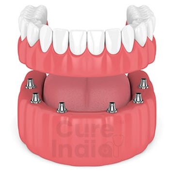 A Comprehensive Guide to Choosing the Right Type of Dental Implant