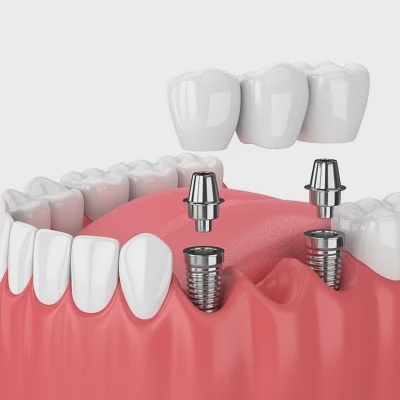 Post-Operative Care for Dental Implants: Ensuring Long-Term Success