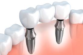 Innovative Dental Solutions: Exploring Implant Techniques in Dubai