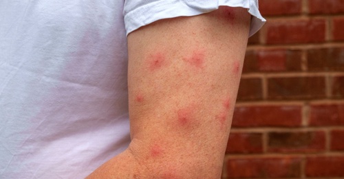 Home Remedies for Treating Mosquito Bites