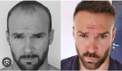 Hair Transplants: Restoring Confidence and Natural Appearance