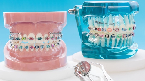 How to Maintain Oral Hygiene with Braces