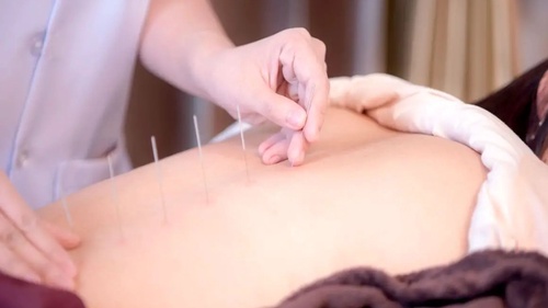 Needling Away Discomfort: The Role of Acupuncture in Chronic Back Pain Management