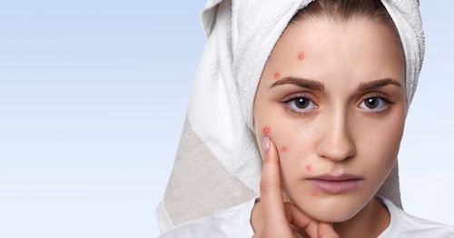 Exploring Homeopathic Treatment for Acne