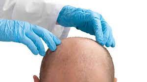 Expected Results and Timeline for Hair Transplant in Abu Dhbai