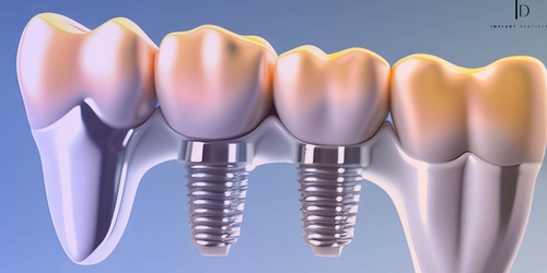 What Are the Main Reasons for Considering Dental Implants?