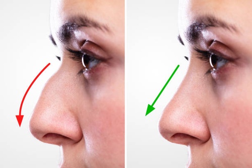 Exploring Nose Rhinoplasty Costs in Mumbai: A Comprehensive Guide