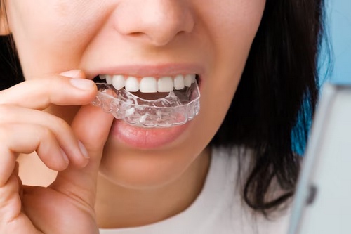 Choosing the Right Invisalign Provider: Your Guide to a Confident Smile
