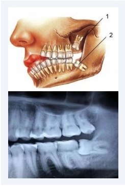 Know How The Wisdom Teeth Extractions Process is Done